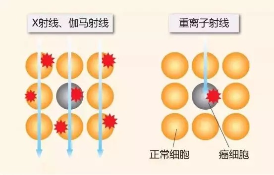 質(zhì)子重離子技術(shù)醫療險可以報銷(xiāo)嗎？