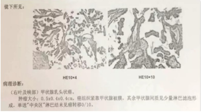 別慌，甲狀腺疾病還可以這樣投保！