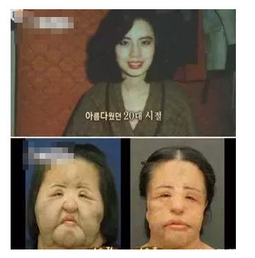 整容發(fā)生意外保險賠嗎？